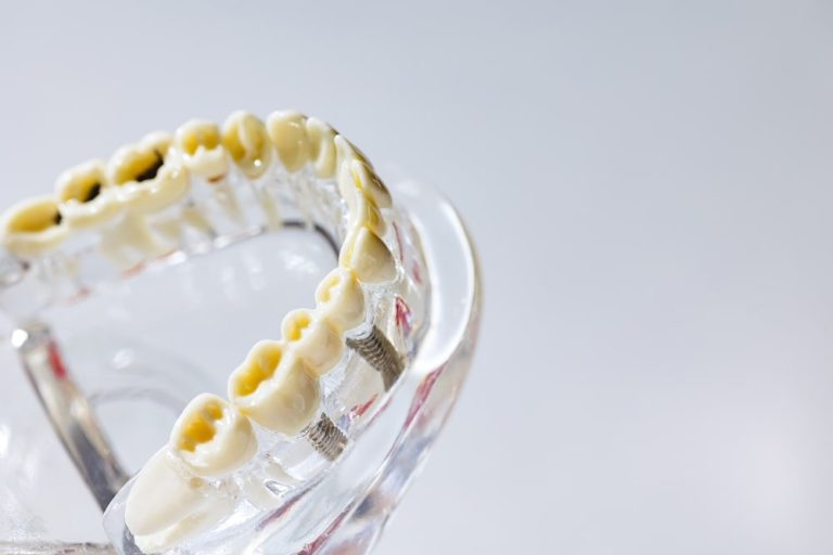 Maquette de dents touchées par la carie dentaire