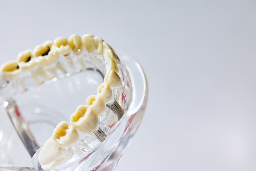 Maquette de dents touchées par la carie dentaire