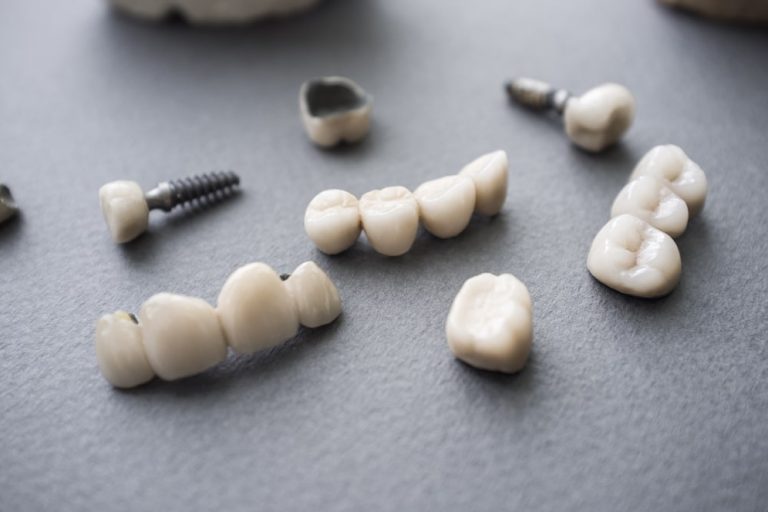 Different types of dental restoration, like a crown, a bridge and an implant-supported restoration