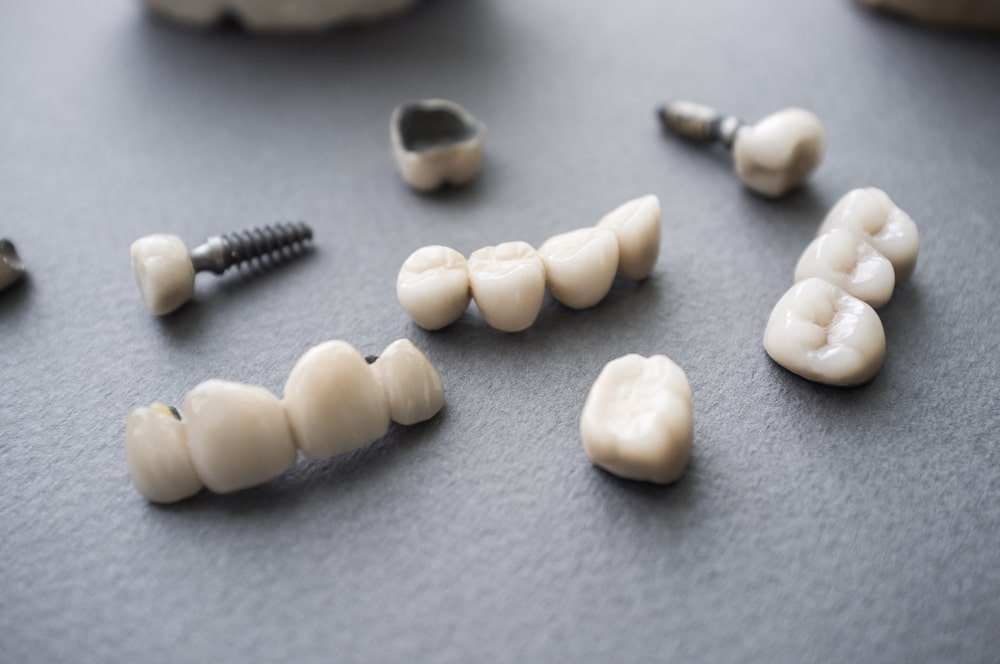 Restauration_dentaire_couronne_pont_implants_Dentiste_Lasalle Différents types de restauration dentaire, comme une couronne, un pont et une restauration sur implant