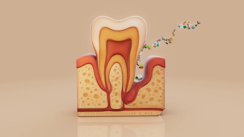 Illustration montrant les effets de la parodontite sur les tissus autour de la dent